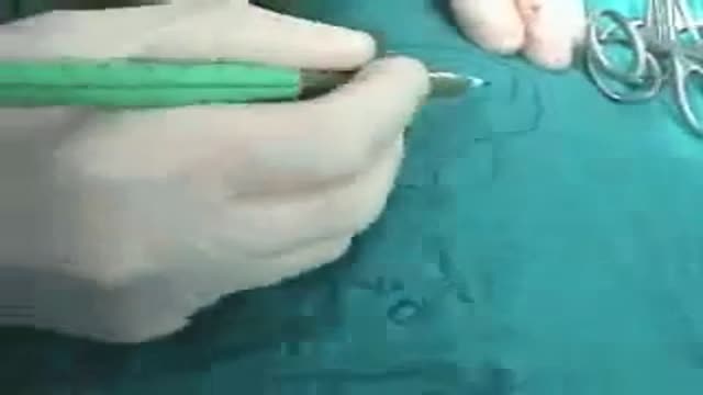 ⁣Penis Hypospedius Repair