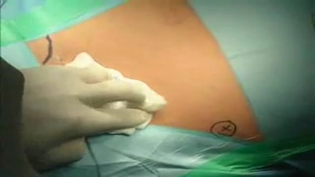 Open Inguinal Hernia Operation (German)