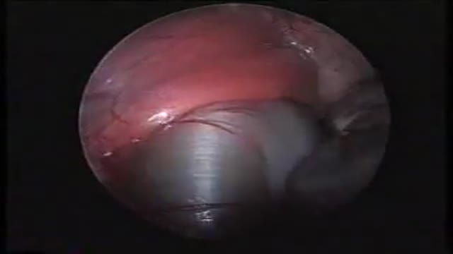 Diaphragmatic Hernia