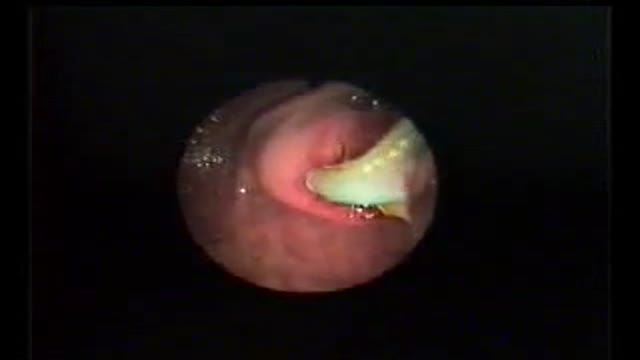 AMAZING WORM EXTRACTION FROM BILE DUCTS