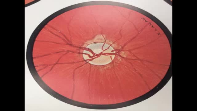 ⁣Palmitoylethanolamide in glaucoma, retinoprotection and improving ou