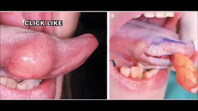 ⁣Tongue Lipoma