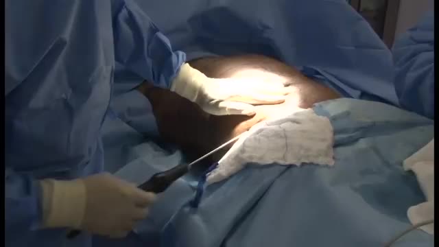 ⁣4D vaser high definition liposuction by Dr. Sanjay Parashar