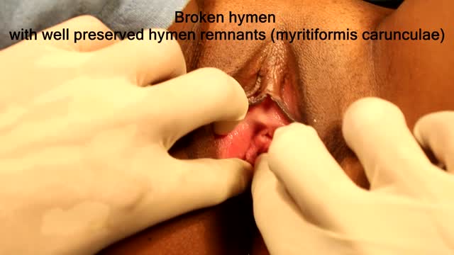 Hymenoplasty / Hymen Repair Surgery Delhi
