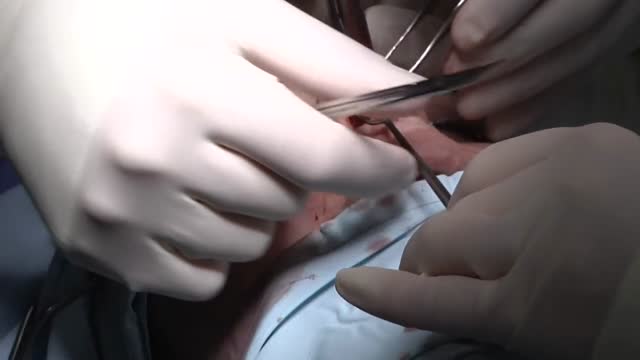 Nose Job - Rhinoplasty Surgery