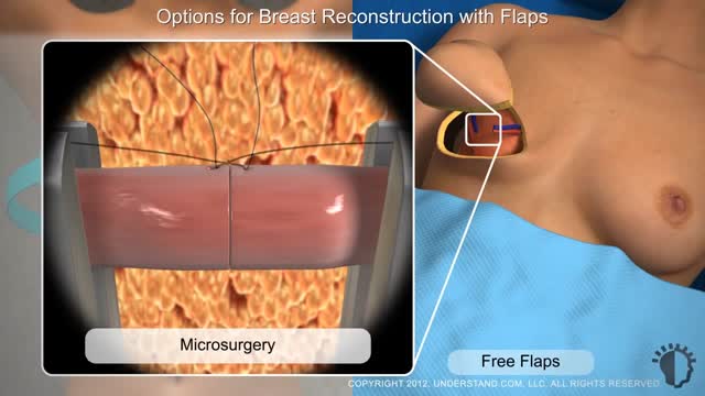⁣What is Breast Reconstruction?