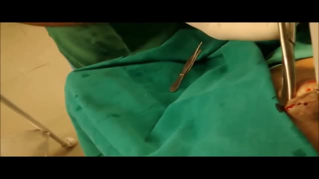 ⁣Cyst in the scalp removal surgery