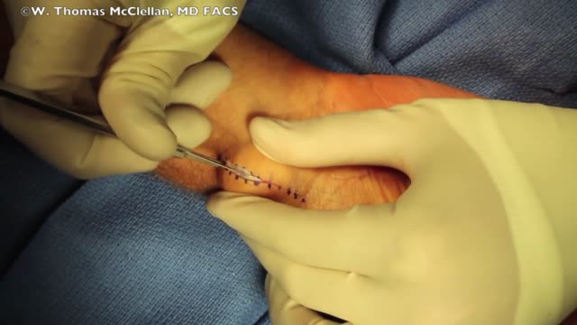 Ganglion Cyst Removal Surgery