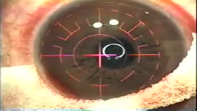 Lasik Eye Surgery Video