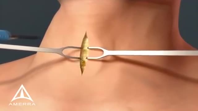 ⁣Tracheotomy Procedure Medical Animation