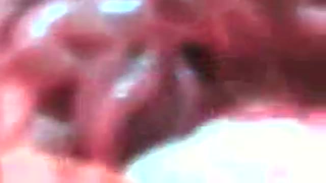 Aneurysm of Splenic Artery