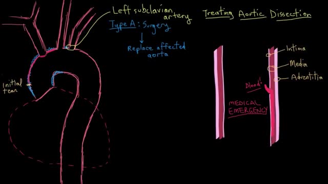 Aortic dissection treatment