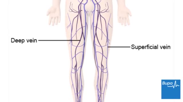 ⁣How deep vein thrombosis (DVT) forms