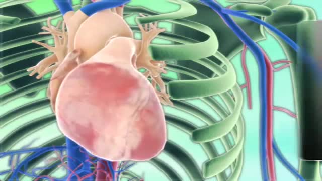 ⁣Cardiac Tamponade