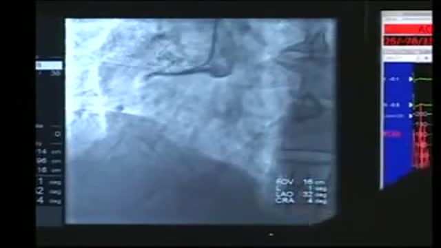 ⁣Cardiac Cath with Angioplasty