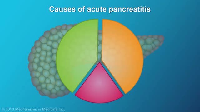 ⁣Acute Pancreatitis