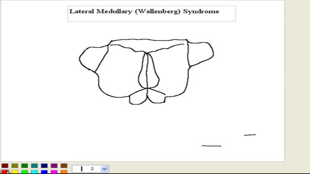 ⁣Wallenberg Syndrome