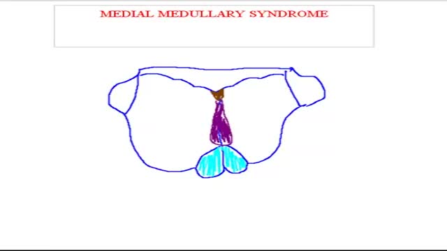 ⁣Medial Medullary Syndrome