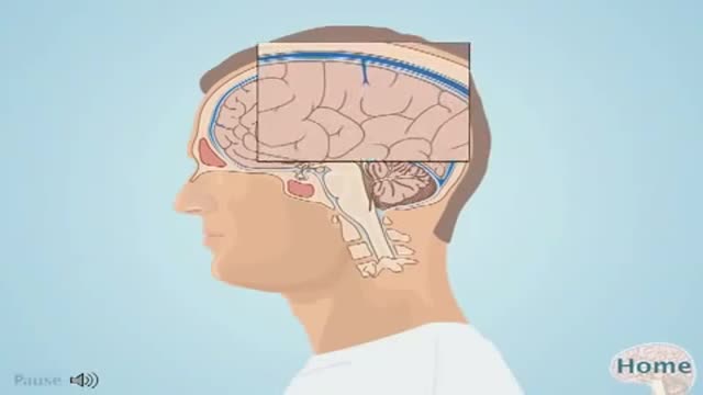 Subdural Hematoma