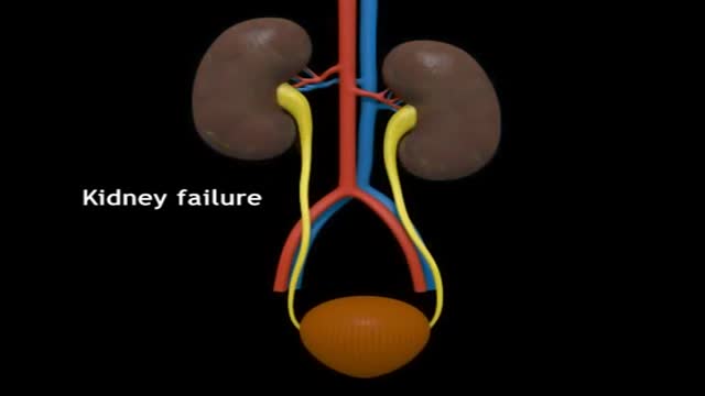 Kidney Transpalantation