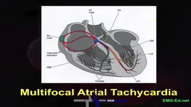 EKG Interpretation Part 3