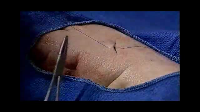 All Suture Techniques Part 2