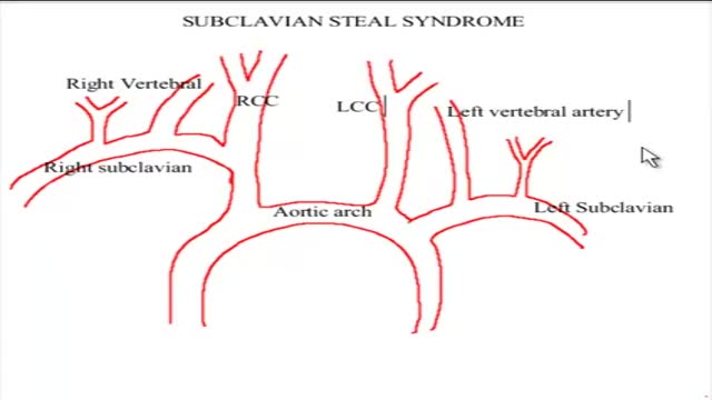⁣Subclavian Steal Syndrome