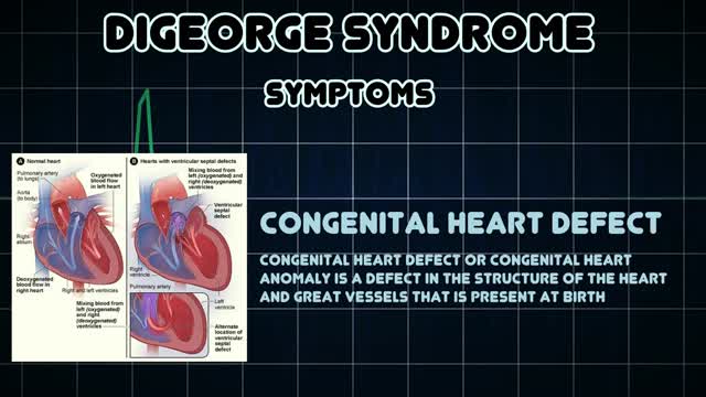 DiGeorge syndrome