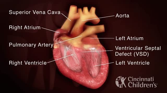 Tetralogy of Fallot