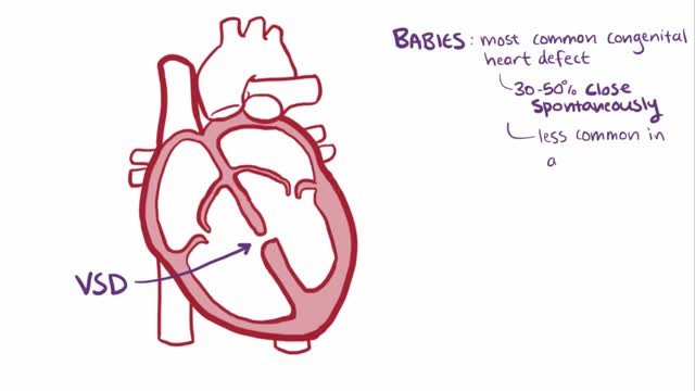 ⁣Ventricular septal defect (VSD)