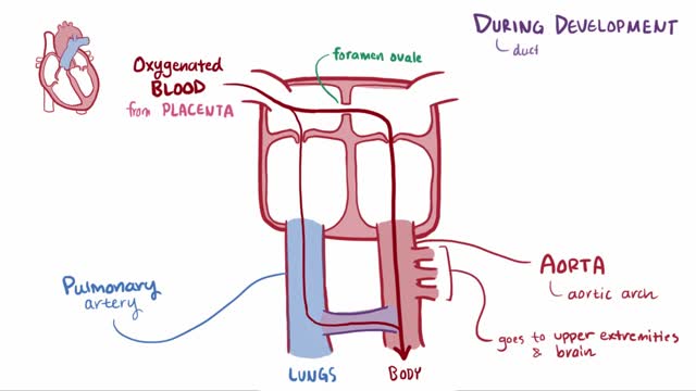 Patent ductus arteriosus (PDA)