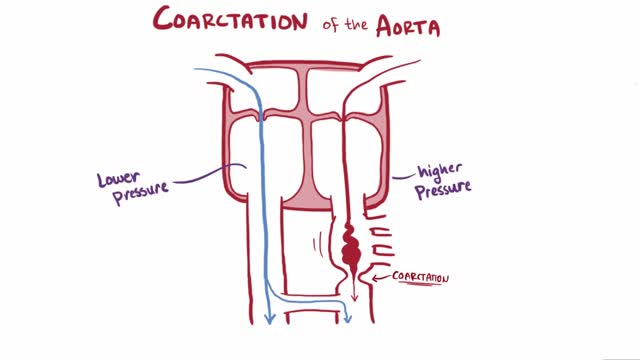 ⁣Coarctation of the Aorta (CoA)