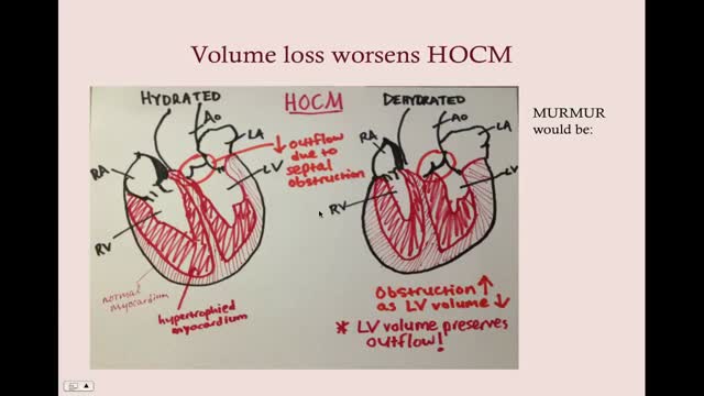 Cardiomyopathies