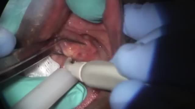 ⁣Removal of a HUGE salivary stone