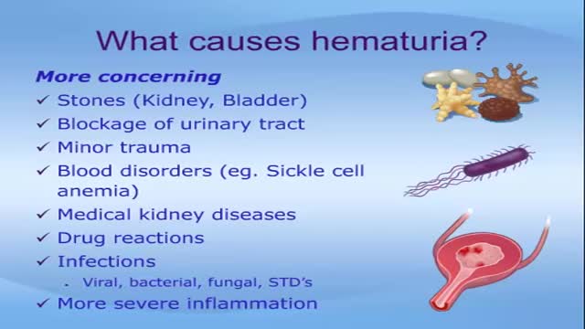 Hematuria