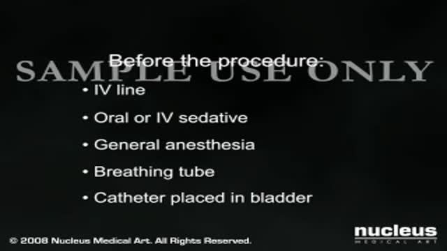 ⁣Heart Bypass Surgery (CABG)