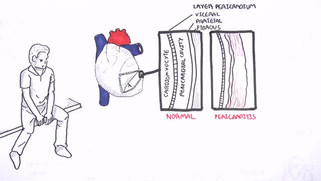 ⁣Pericarditis Information