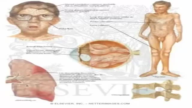 Homocystinuria