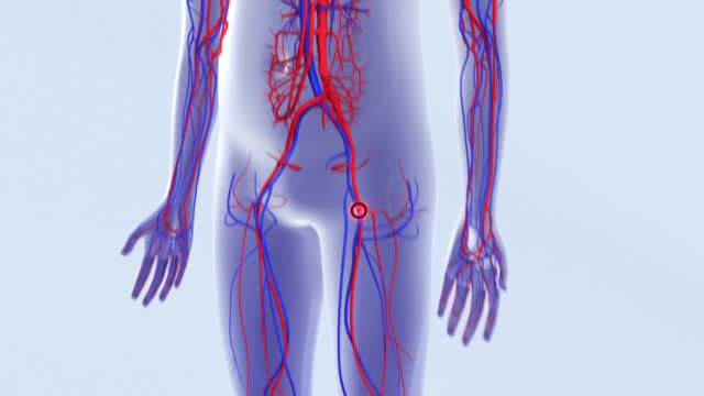 Deep Vein Thrombosis