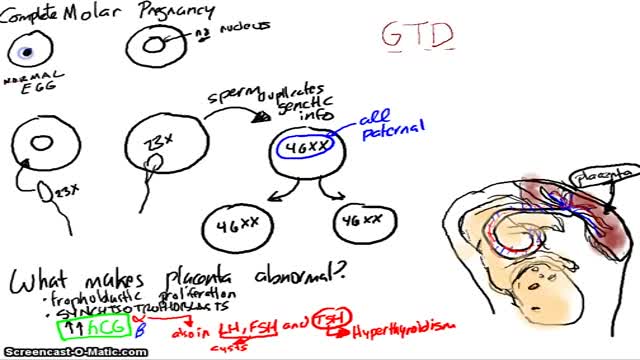 Molar Pregnancy