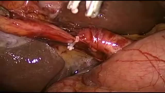 ⁣Laparoscopic Cholecystectomy Video