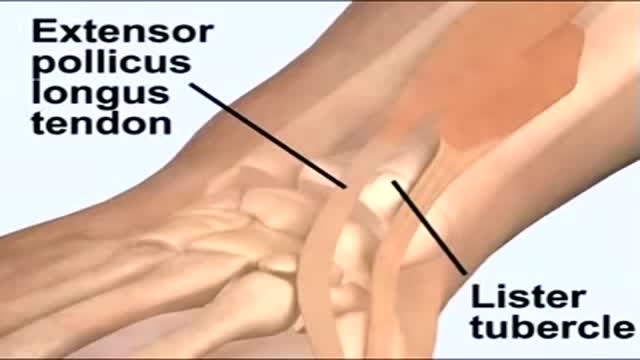 ⁣Wrist Arthrocentesis