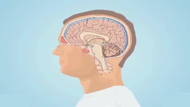 ⁣Subarachnoid Hemorrhage