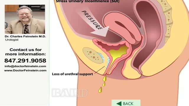 ⁣Urinary incontinence