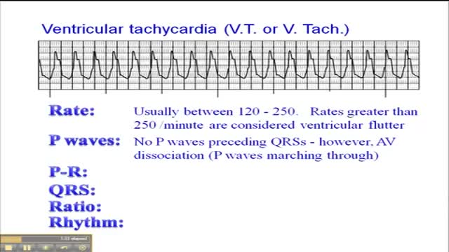 ⁣Ventricular Tachycardia