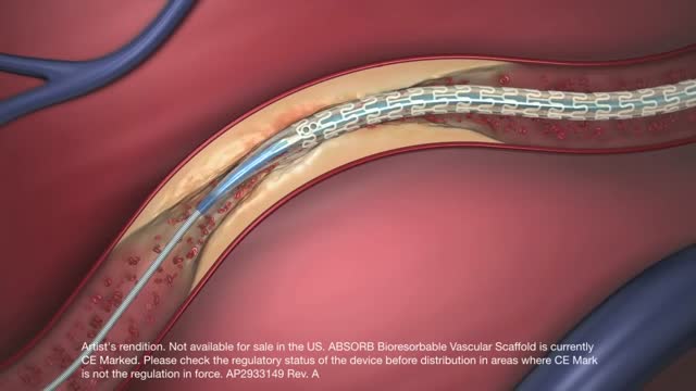 ⁣Dissolving stent restores blood flow to heart