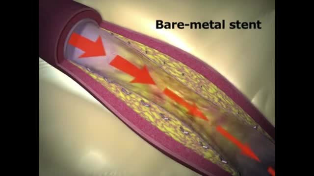 Different types of Heart Stents