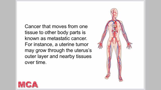 Uterine cancer