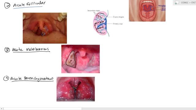 Tonsilitis