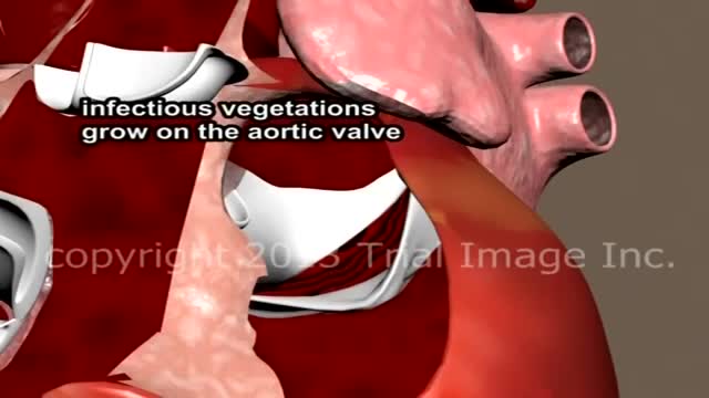 Endocarditis